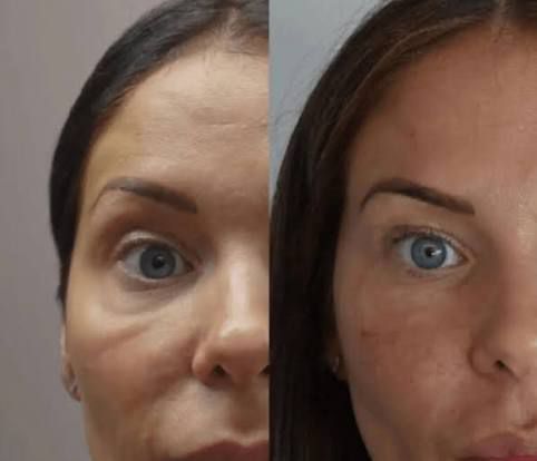 Eye Area Rejuvenation